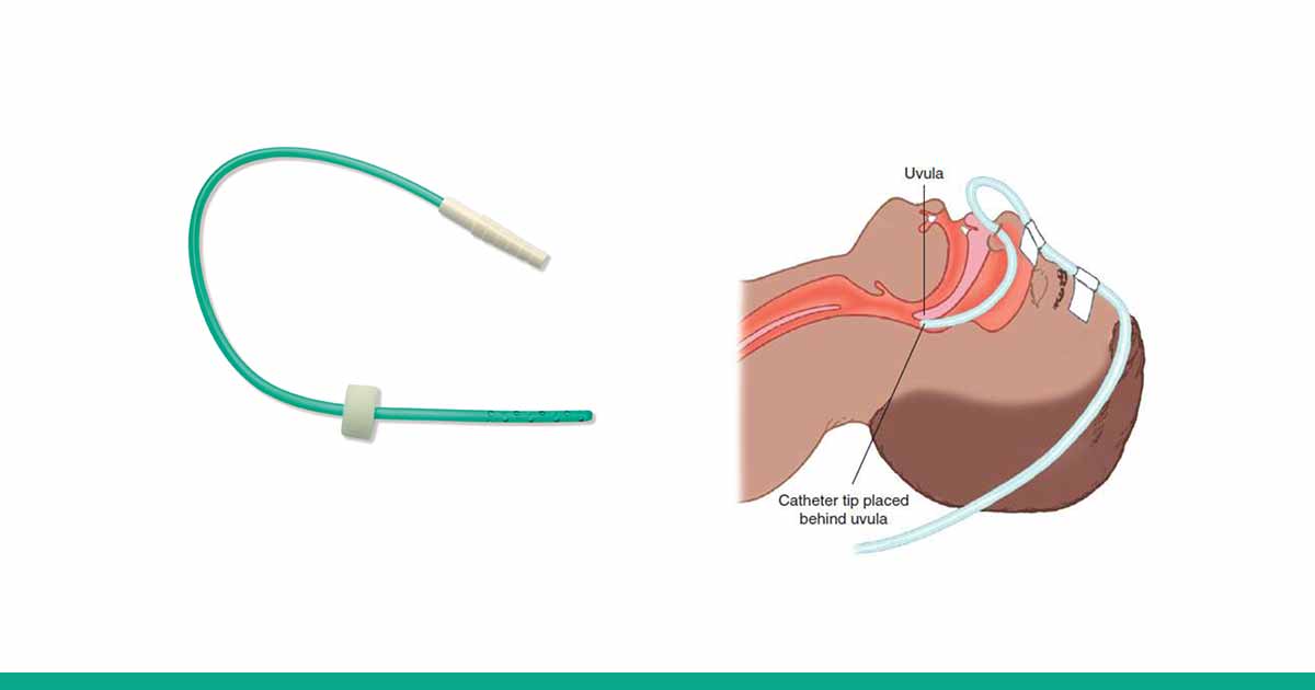 use of nasal catheter, nasal cannula vs nasal catheter