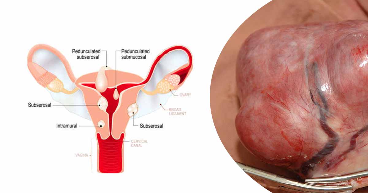 uterine-fibroids-types-prevention-treatment