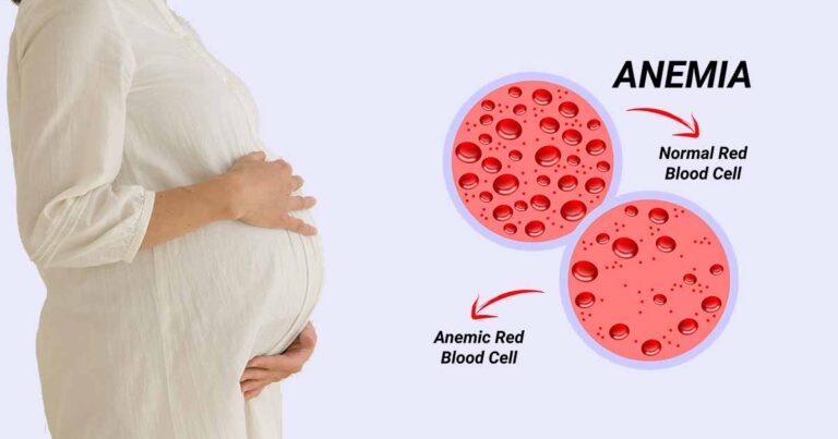 Anemia in Pregnancy Major Causes, Risk factors, Prevention, and Treatment