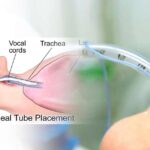 Types & Sizes of Endotracheal Tubes (ETT) Used in Anesthesia and Surgery