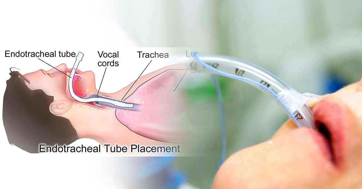 Types & Sizes of Endotracheal Tubes (ETT) Used in Anesthesia and Surgery