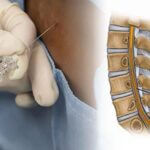 Types of Spinal Needles, and the Uses